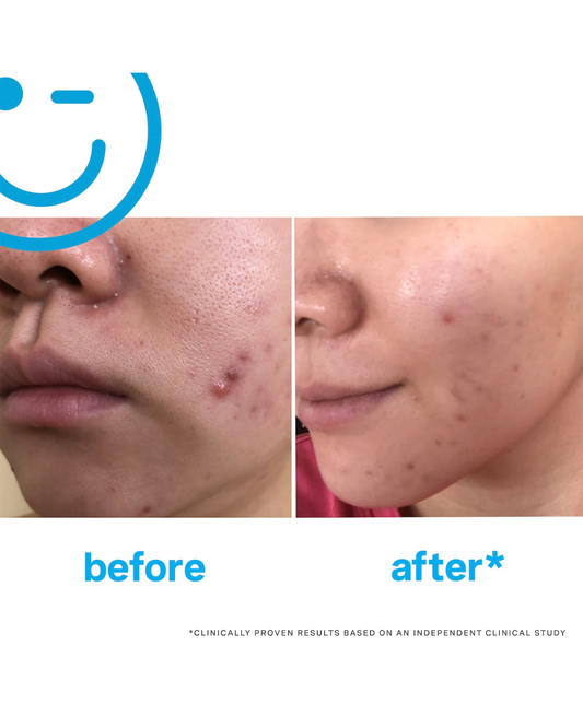 EradiKate™ 3% Sulfur Daily Foaming Cleanser + Acne Treatment
