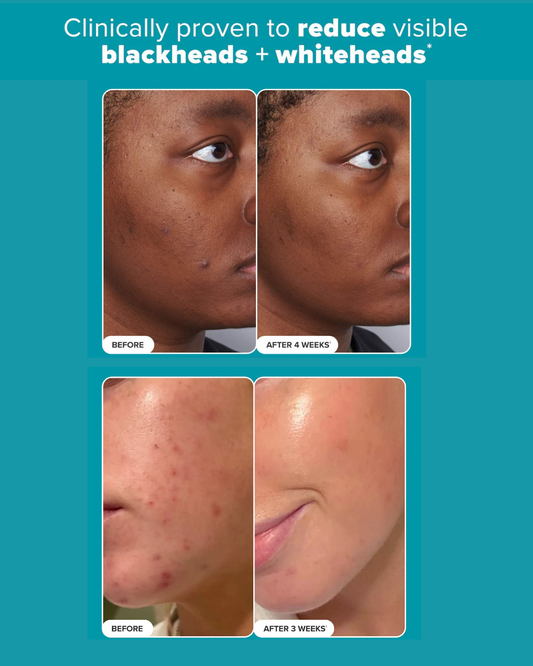 Skin Perfecting 2% BHA Liquid Exfoliating Toner for Clear Skin